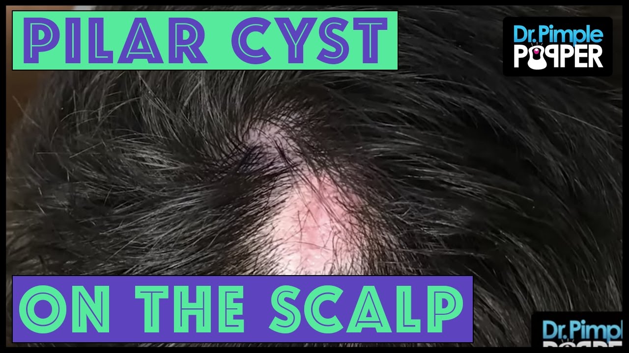 Another One: Three Pilar Cysts Removed