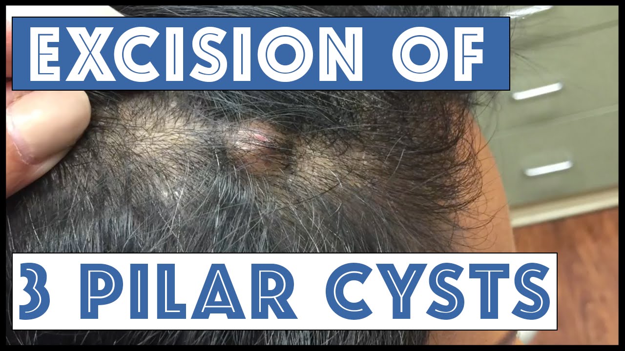 Another scalp with Three Pilar Cysts