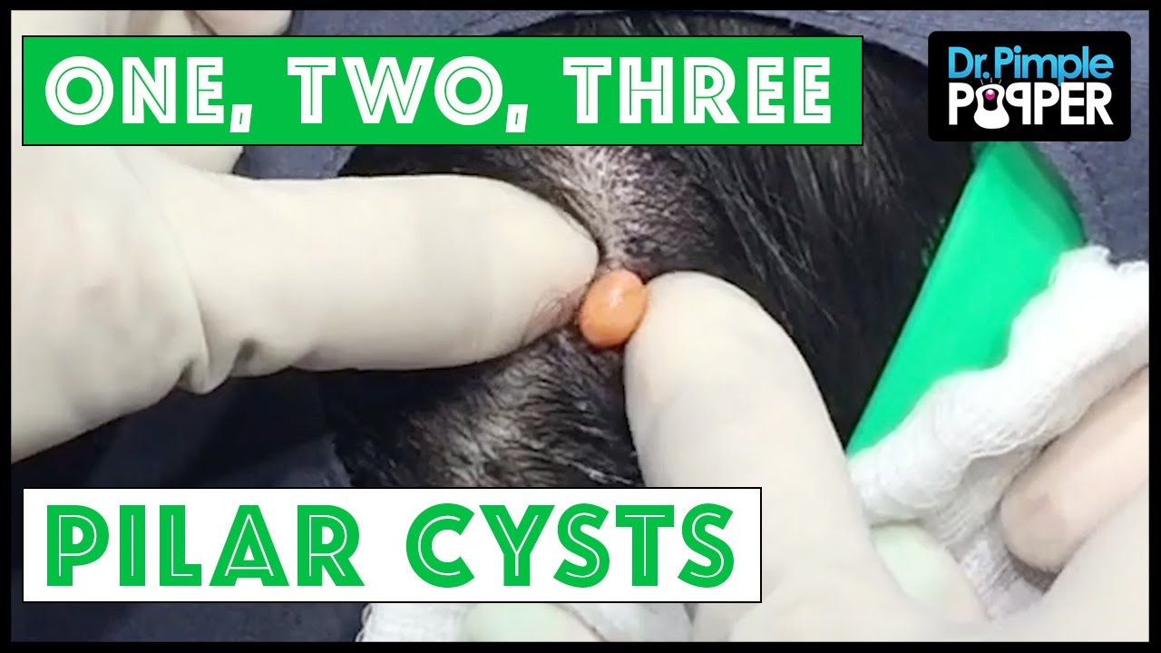 Another Threesome of Pilar Cysts