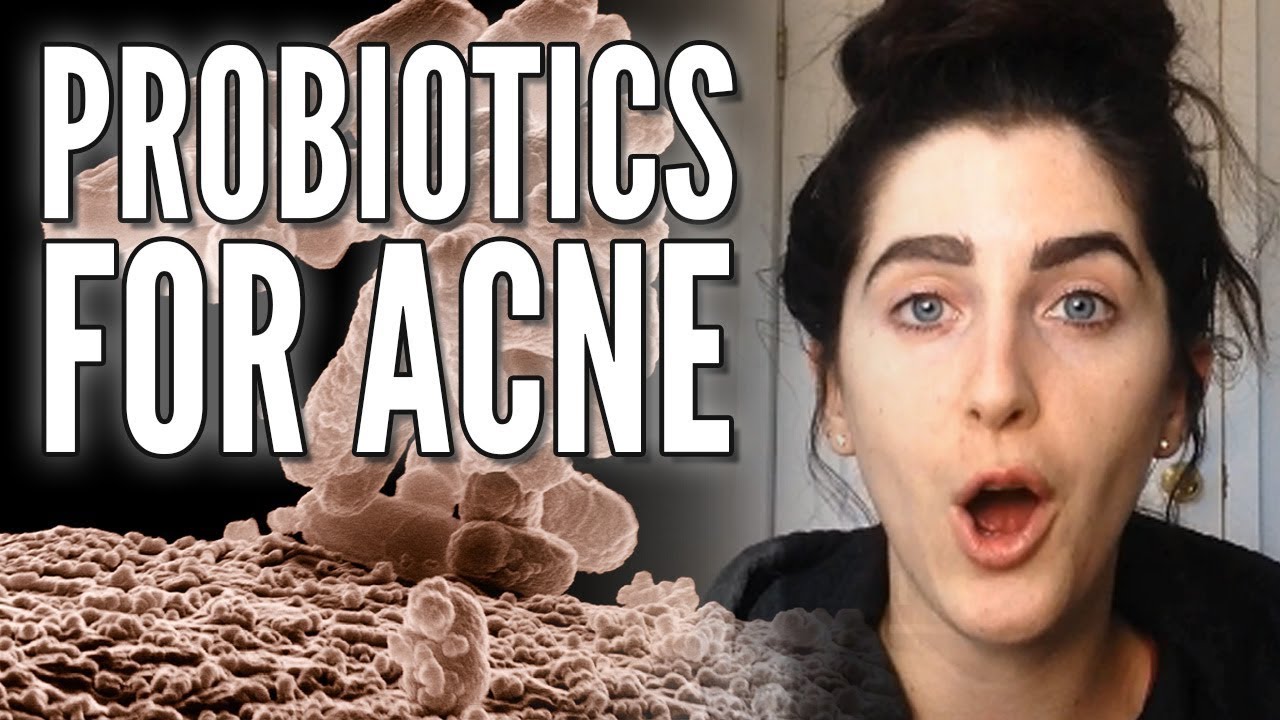 Applying Live BACTERIA to the Skin to Clear Acne! Will you do it?