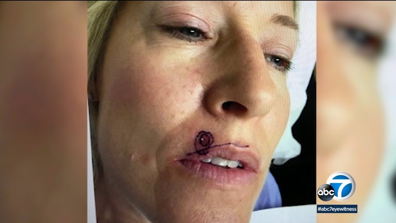 Arcadia woman says apparent pimple above lip was skin cancer | ABC7