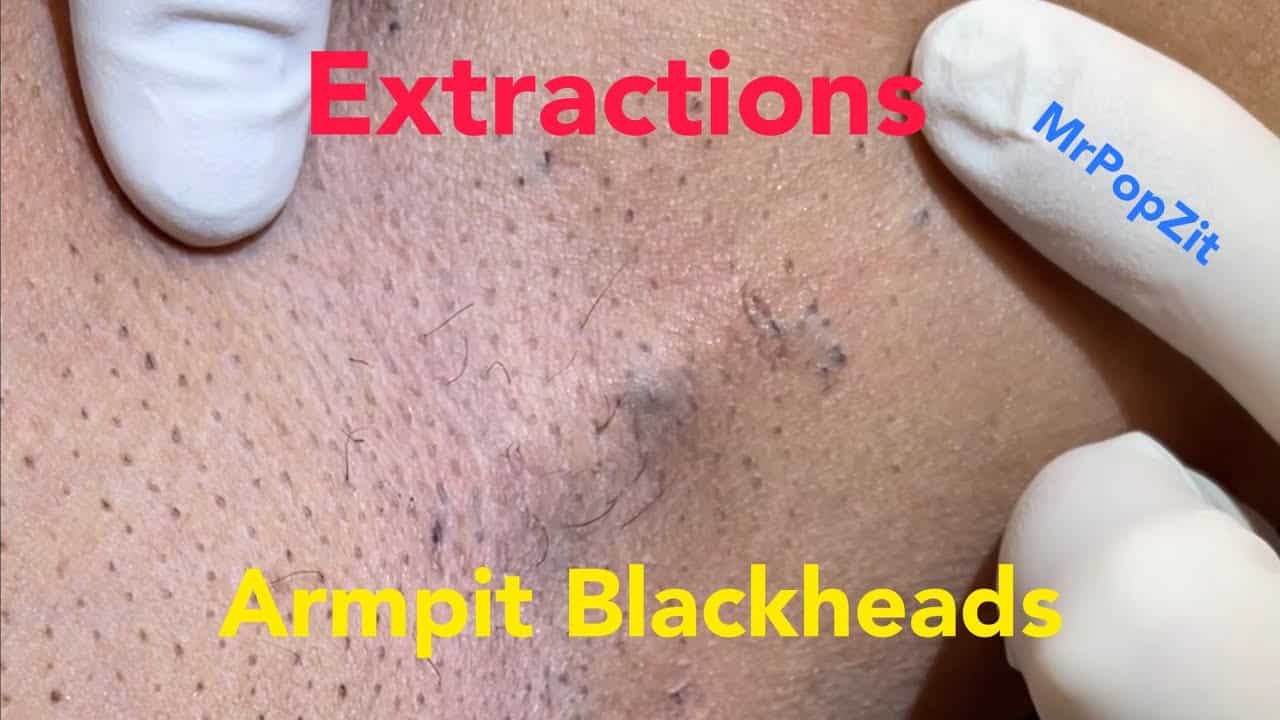 Armpit Blackhead Extractions. Multiple clogged pores and follicular cysts cleared. Ingrown hairs.