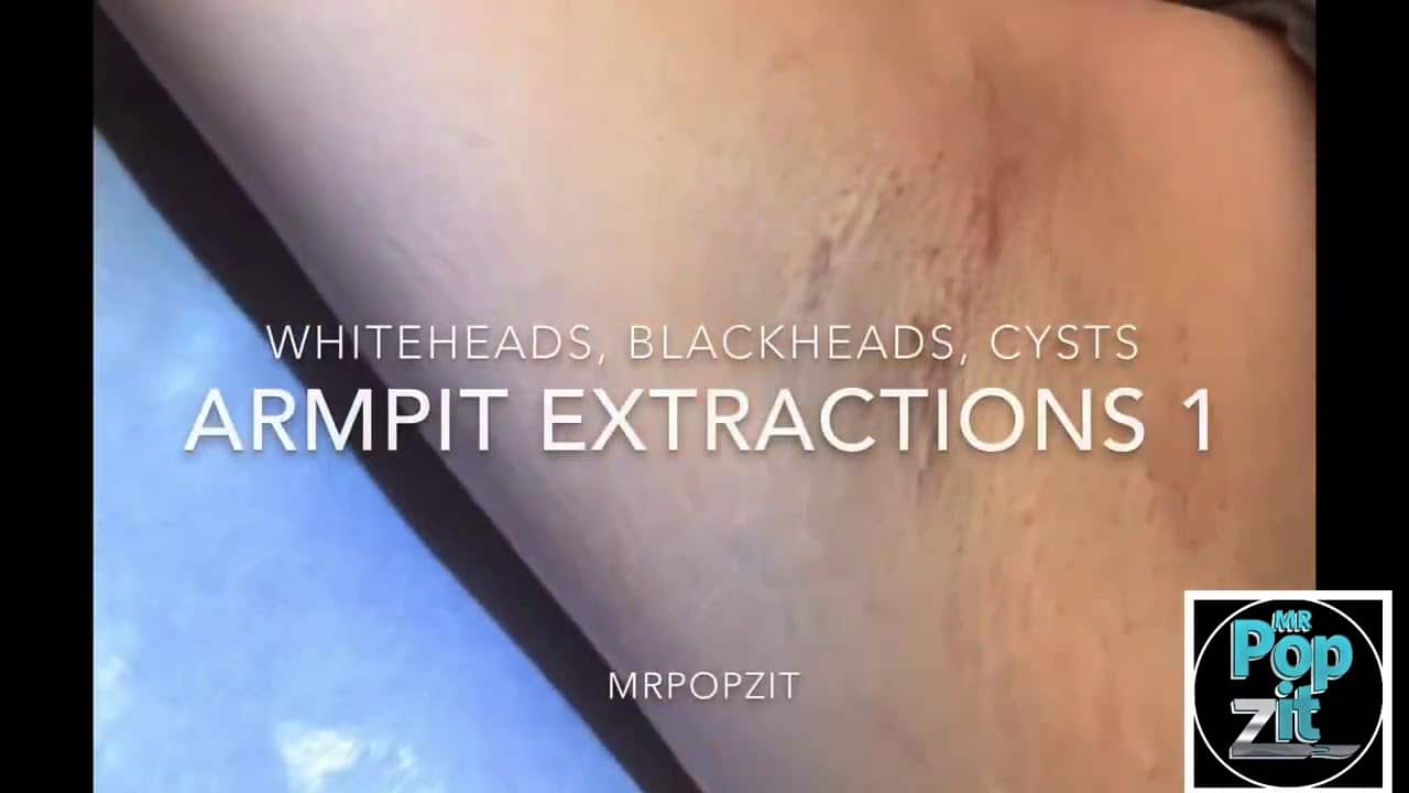 Armpit extractions #1. Blackheads, whiteheads, milia. Small cyst pops. Hidradenitis scars of axillae