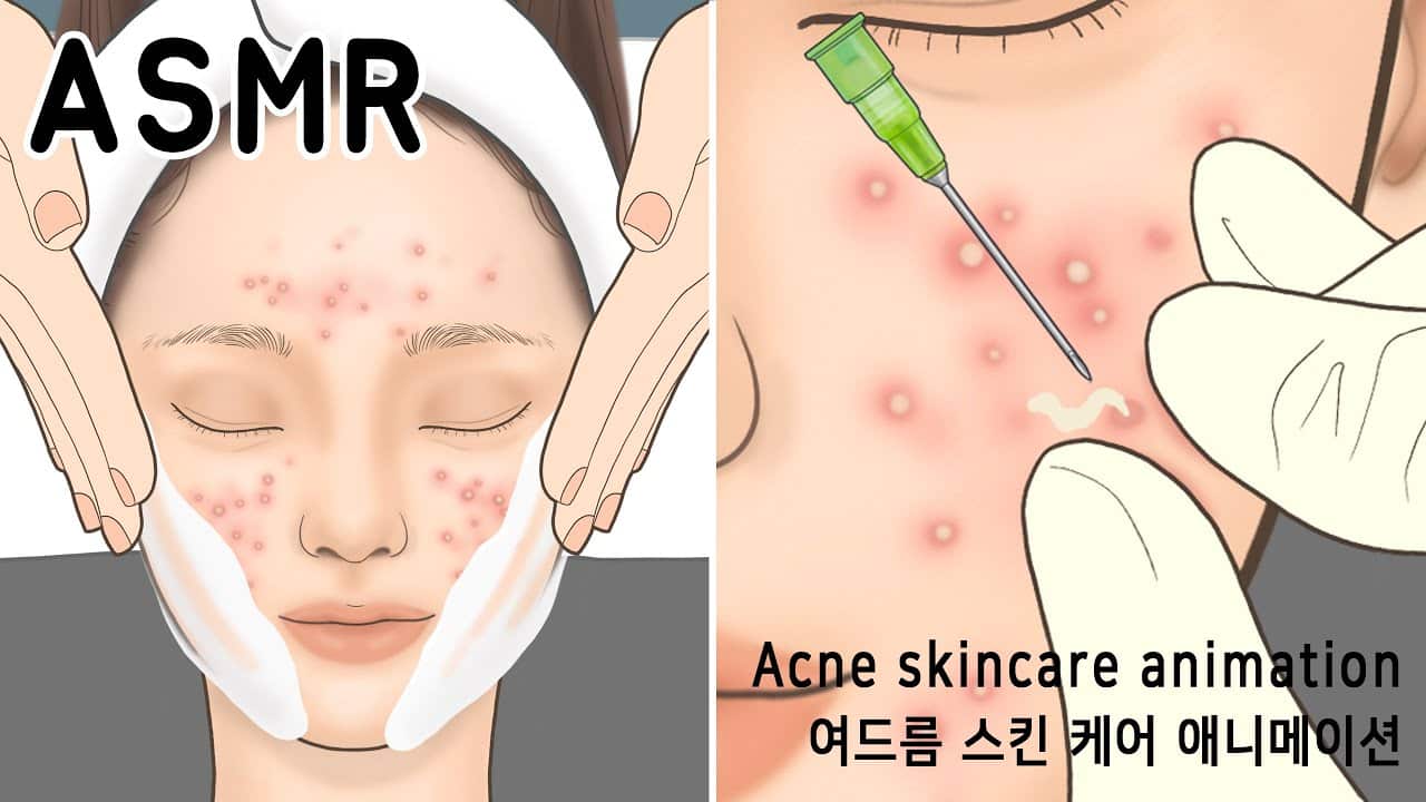 ASMR 팅글 주의! 여드름 피부 관리 애니메이션 | 여드름 압출 | Acne Removal Skin Care | Acne extract