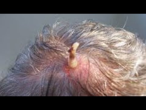 ASTONISHING BOTFLY REMOVAL | PIMPLE POPPING