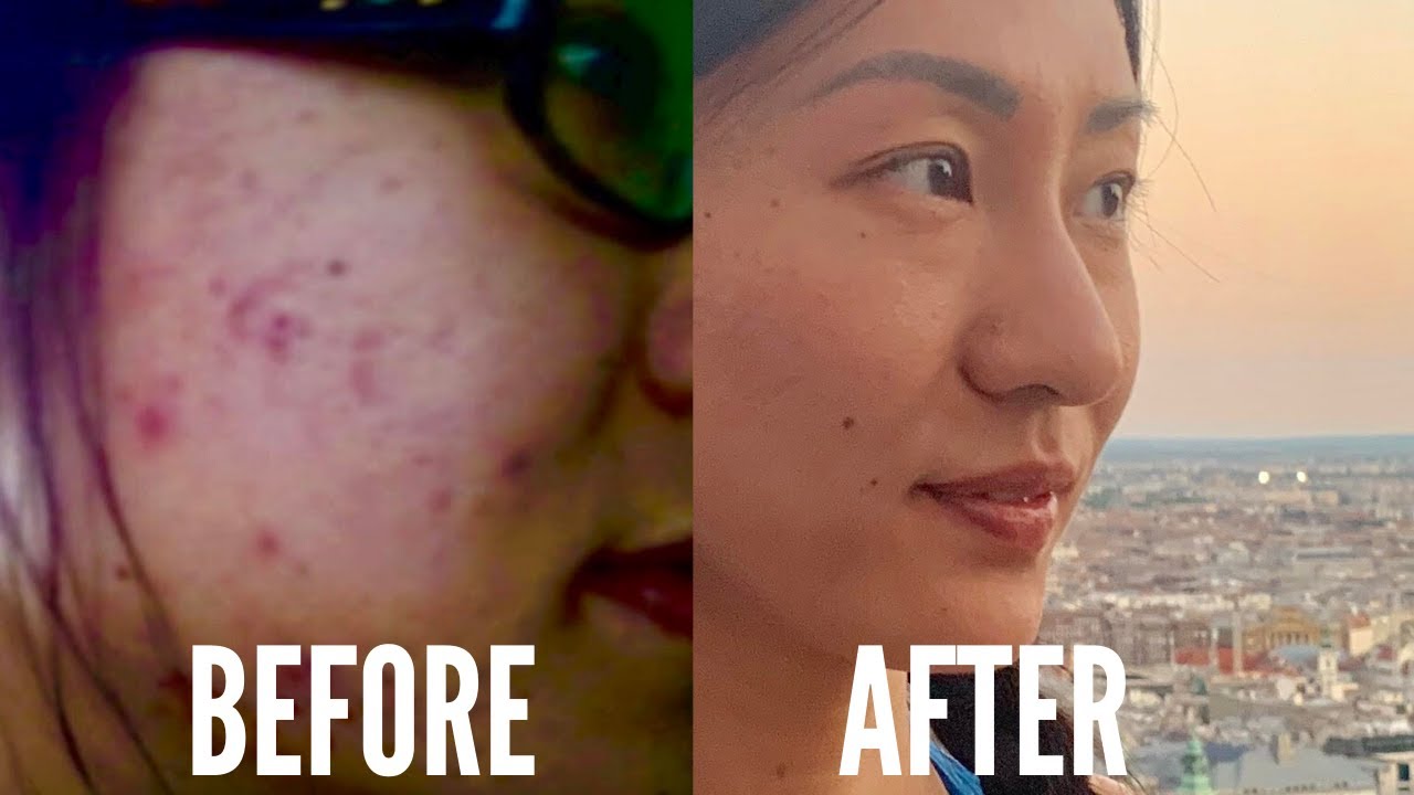 At Home Acne Scar Facial Treatment Using BANISH Starter Kit 2020