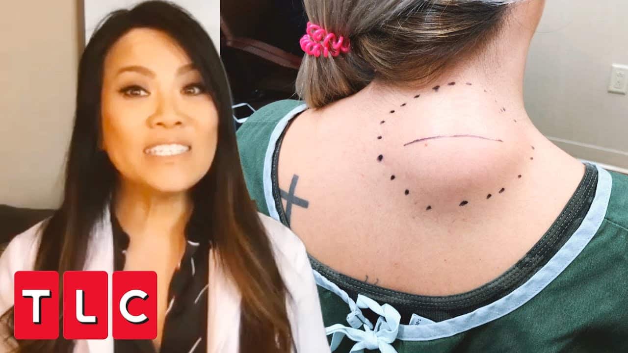 Attack of the Back Lipoma | Dr. Pimple Popper: This is Zit