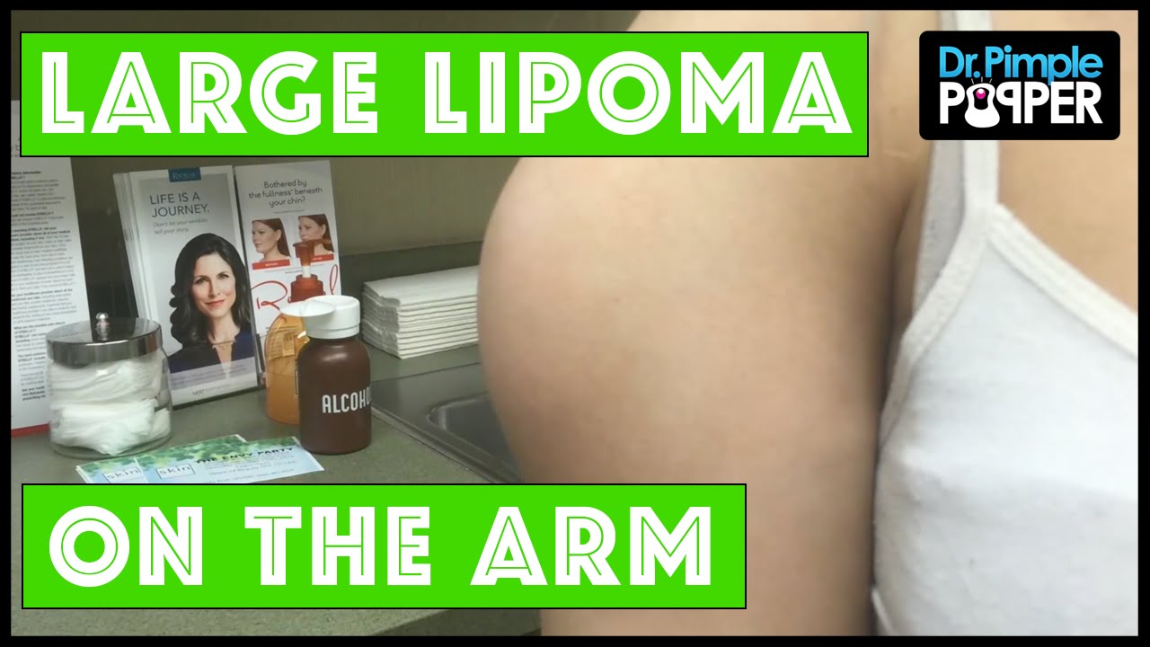 ATTENTION: THIS IS NOT A DELTOID MUSCLE  with Dr Pimple Popper