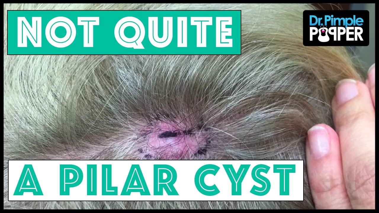 Attention: This was not a pilar cyst.  A Dr Pimple Popper Warning!