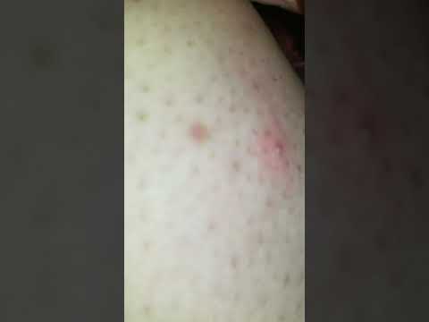 Audible little pimple pop on my leg