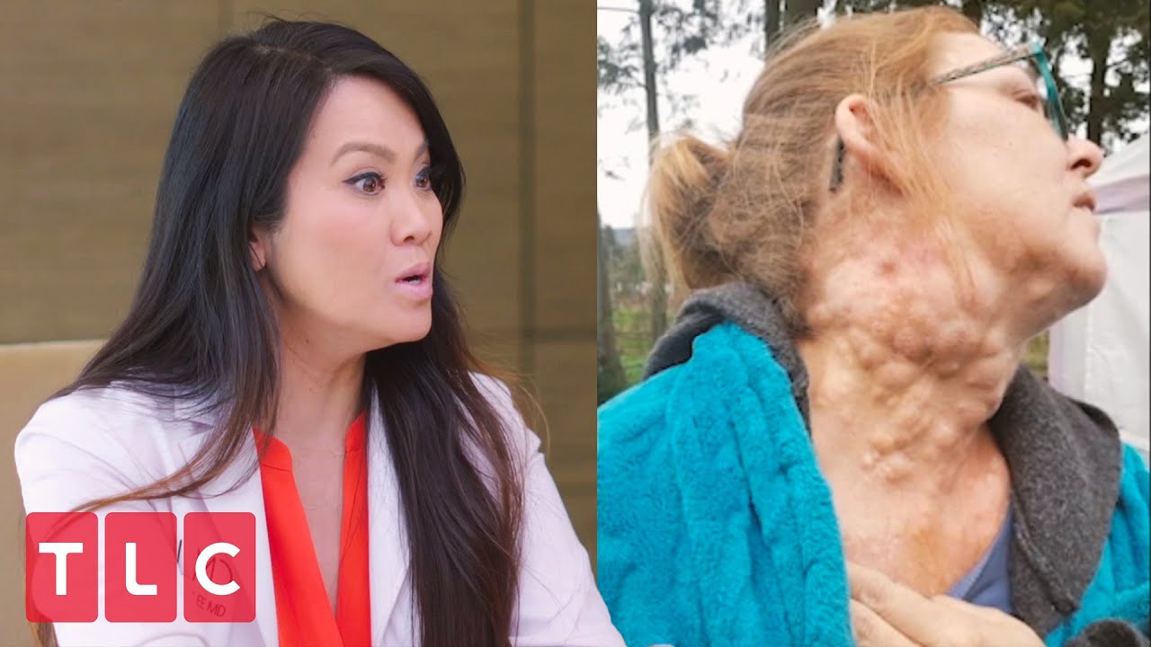 Audrey's Neck Is Covered in Cysts! | Dr. Pimple Popper: Before the Pop
