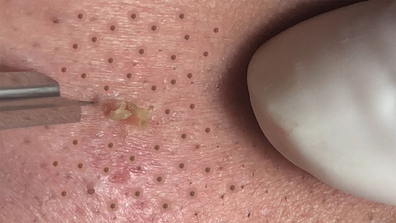 AWESOME BLACKHEADS and ACNE EXTRACTION | Suri Job 150