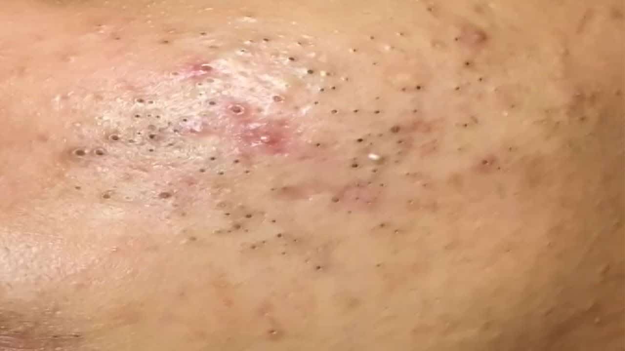 AWESOME BLACKHEADS and HIDDEN ACNE POPPING | Suri Job 132