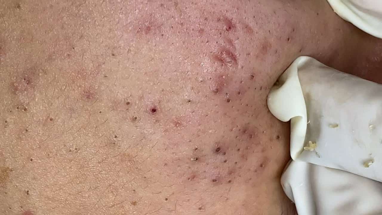 AWESOME BLACKHEADS POPPING FOR NEW YEAR | Suri Job 143