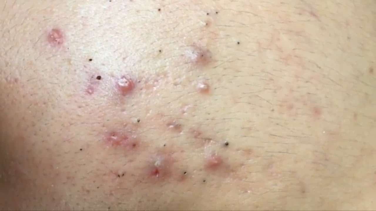 AWESOME LIND PIMPLES POPPING | Suri Job 111