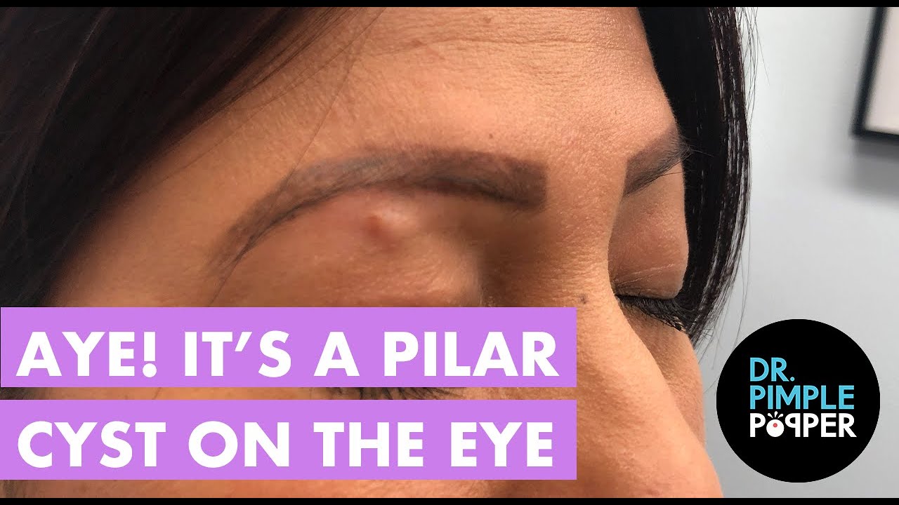 Aye! A Pilar Cyst on the Eye