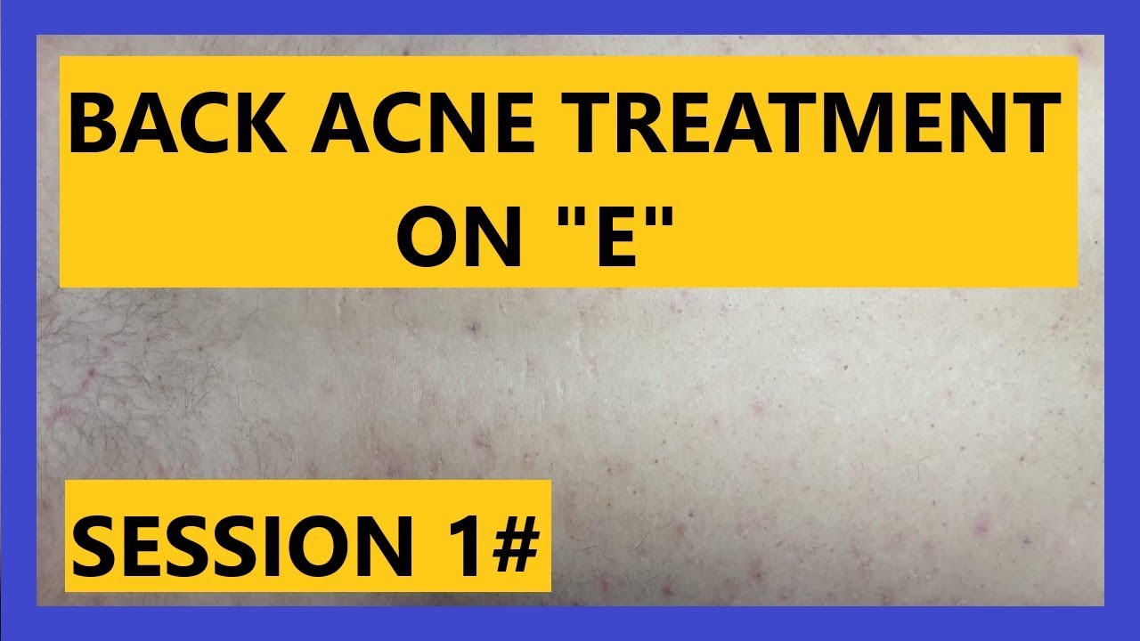Back ACNE Treatment on “E”   (SESSION #1)