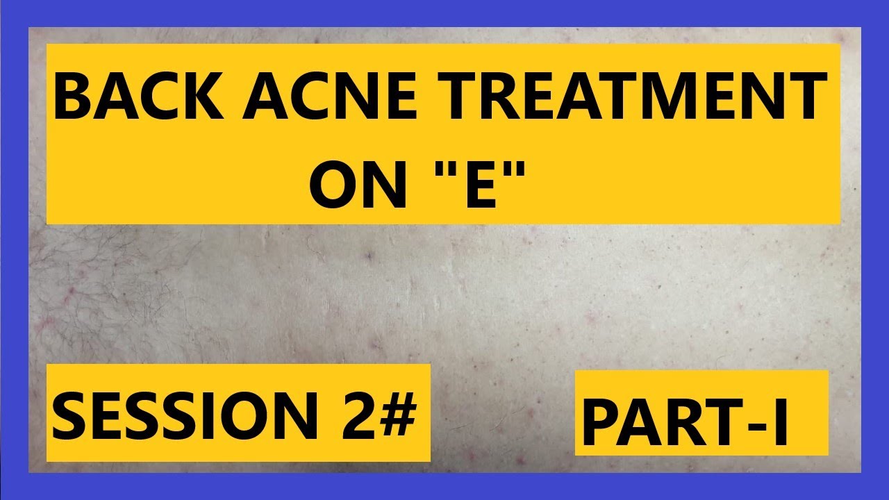 Back ACNE Treatment on  “E” (SESSION #2) Part I