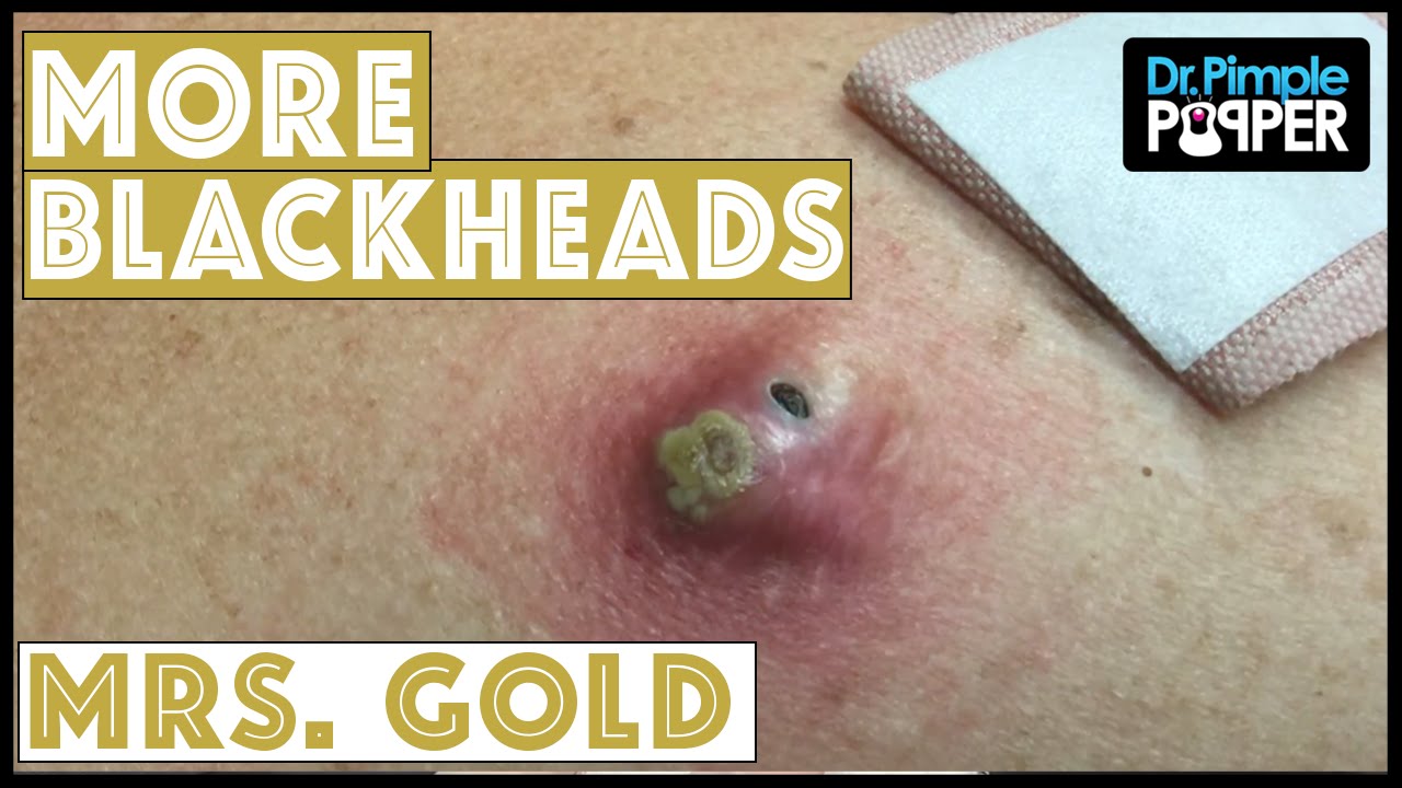 Back Blackhead Extraction Session #2 in “Mrs Gold”-Addressing the Inflamed One