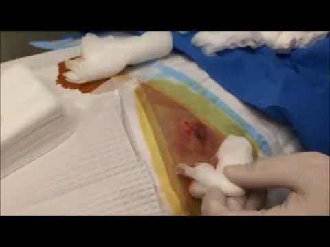 Back Cyst, Infection, Abscess or Zit?  (EXTENDED) Popping Pus Filled Pimples