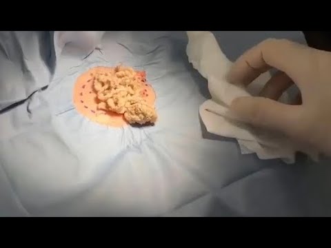 Back Cyst Popping