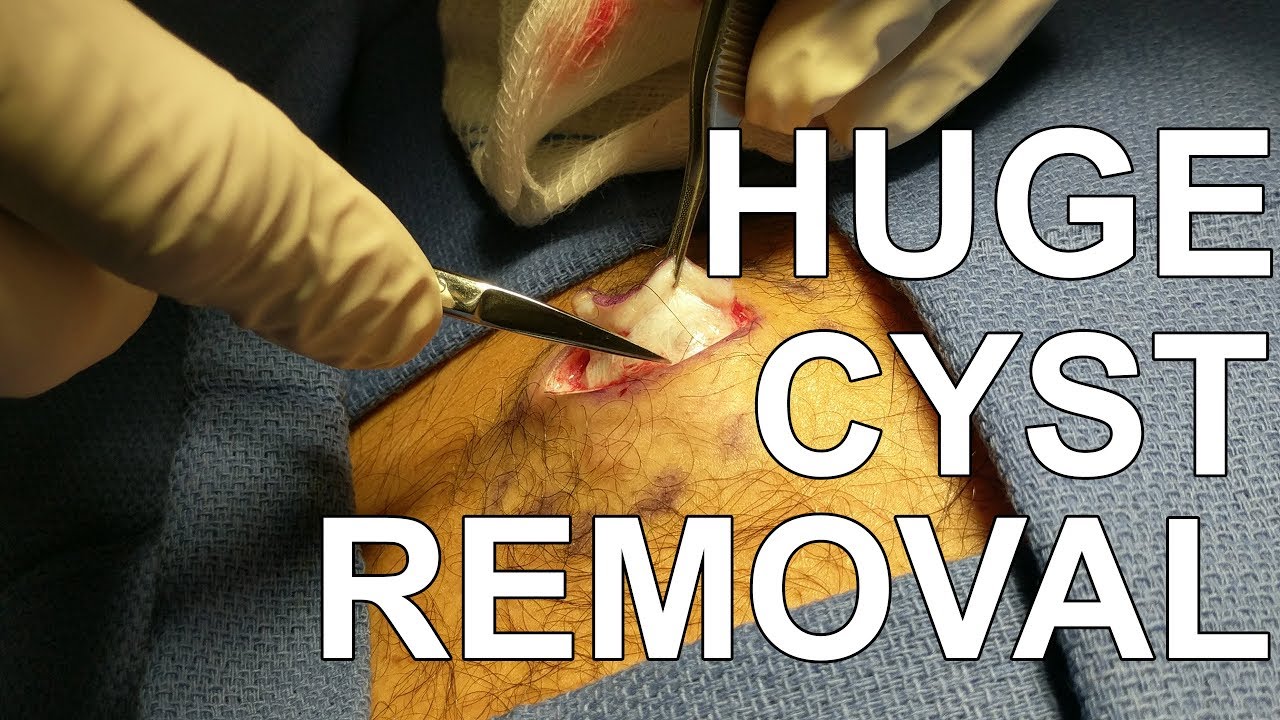 Back Cyst Removal – Dr. Paul Ruff | West End Plastic Surgery