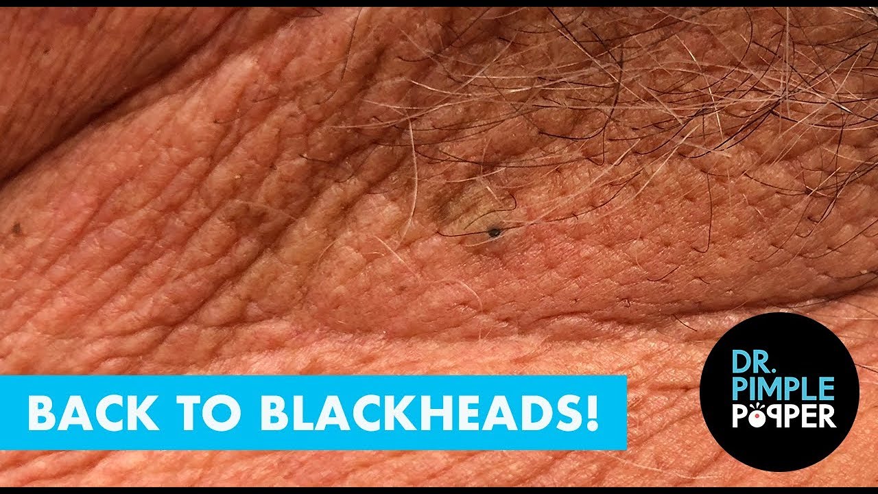 Back to Blackheads!
