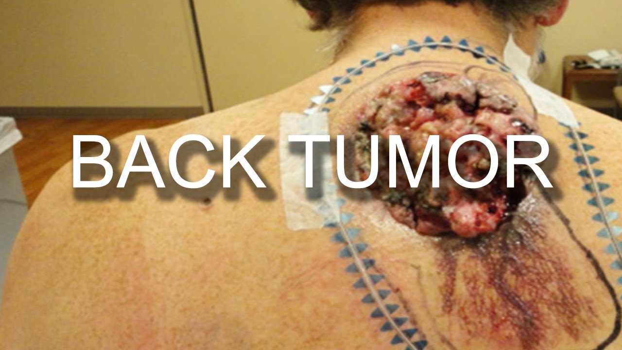 Back Tumors, Cysts, Fungating Tumors:  Treatment, Surgery and Popping