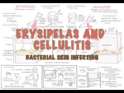 Bacterial Skin Infection – Cellulitis and Erysipelas (Clinical Presentation, Pathology, Treatment)