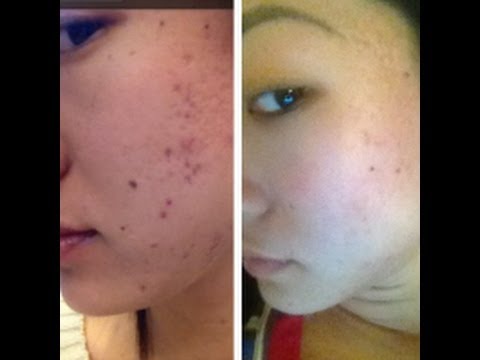 BANISHACNESCARS DERMAROLLER FAQ and Review-getting rid of acne scarring