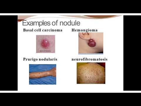 basic terminology used in skin  lesion| macule |papule|pustules|nodule |vesicle |bullae