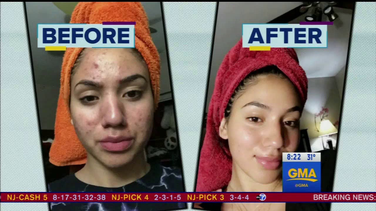 Battling Breakouts: The Facts About Acne
