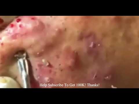 Beautiful Skin Care | satifying video old age blackheads removal  best pimple popping….