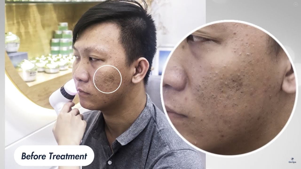 Before & After Blackhead Removal 55min by Gà Spa – Feeling so satisfied!!