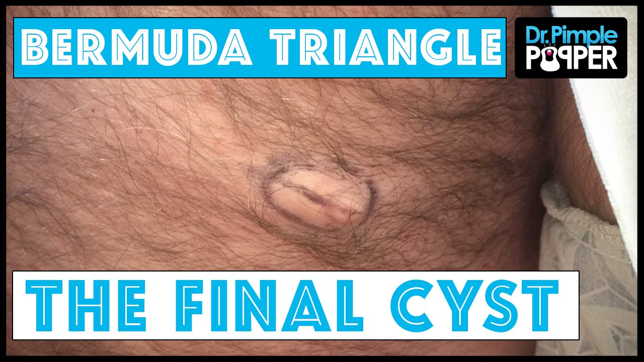 Bermuda Triangle is Back: Hannah & her “Cyst-ers”