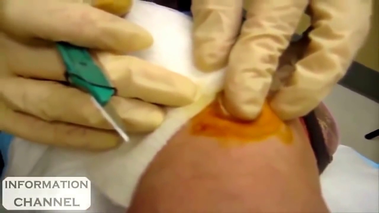 Best back cyst pimple popping Most Amazing Pops