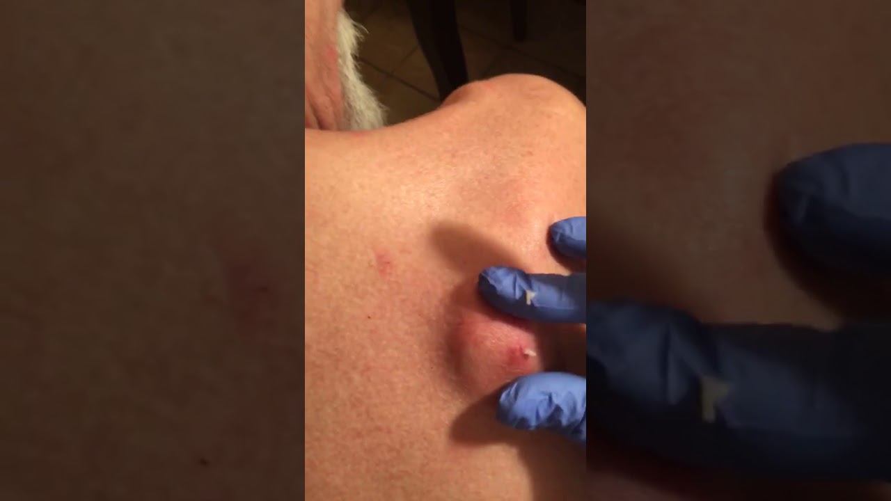 Best Biggest Pimple Pop Ever , Cyst Removal at home 2017