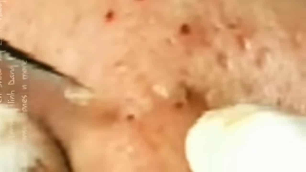 Best blackhead extraction pimple pop full screen
