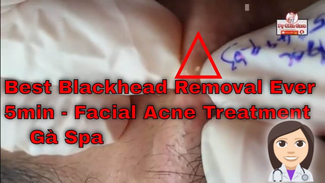 Best Blackhead Removal Ever 5min – Facial Acne Treatment – Gà Spa blackheads  ance …|EP2|