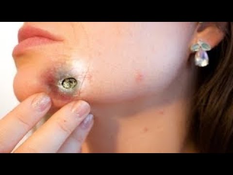 Best blackheads removal #30 (TOTAL SATISFACTION) – NEW Pimple Popping 2021
