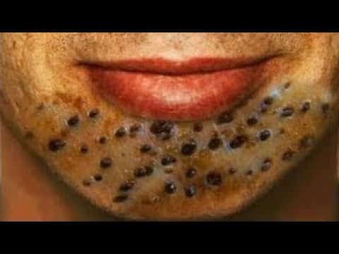 Best blackheads removal #9 (TOTAL SATISFACTION) – NEW Pimple Popping 2021