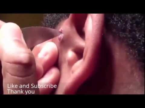 Best Compilation of Pimple Popping