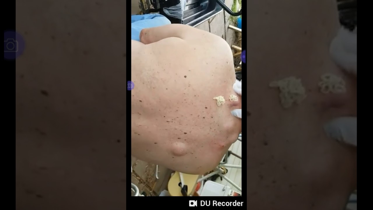 Best cyst squeeze