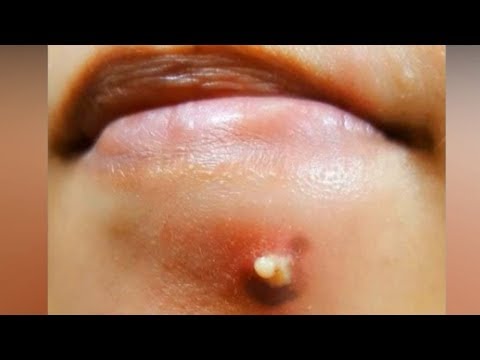 Best Cystic Acne & Top Pimple Pops on Instagram 2018