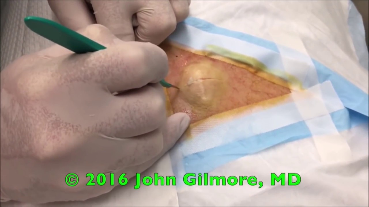 Best Cysts of 2016 – Popping, Removal & Surgery
