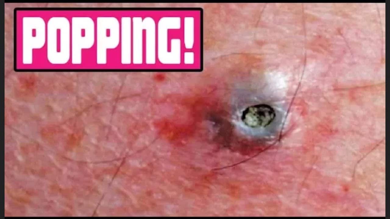 Best Dilated Pore, 12 Pimple Pops, Acne and Dermatology