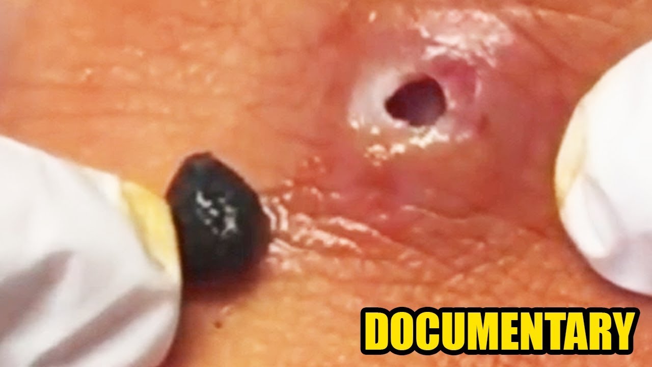 Best DPOW's, Waxing and Pimple Popping