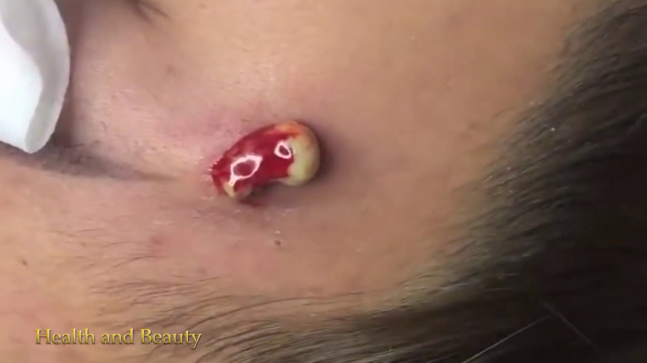 Best extraction Videos – ANCE – Blackheads 2019 #13