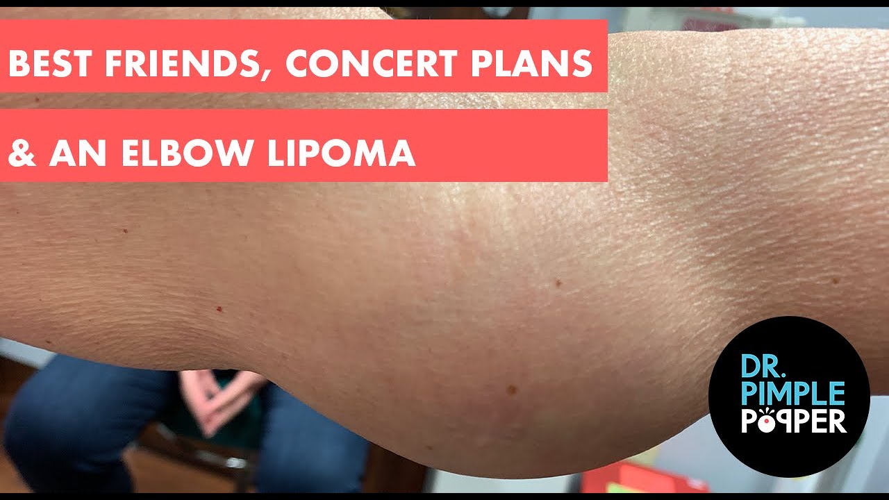 Best Friends, Concert Plans, & An Elbow Lipoma
