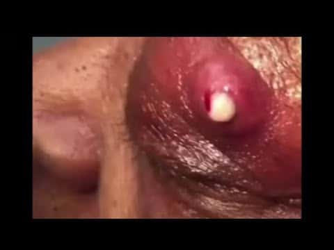 Best new pimple popping, blackhead and cyst extraction videos 2021|| Pimple Haven #6